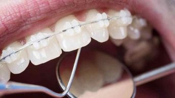 How Braces Can Correct a Range of Orthodontic Issues in Stoke-on-Trent