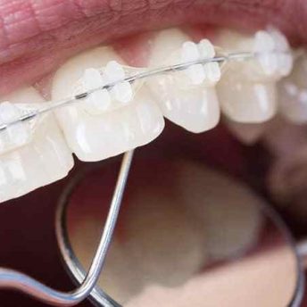 How Braces Can Correct a Range of Orthodontic Issues in Stoke-on-Trent