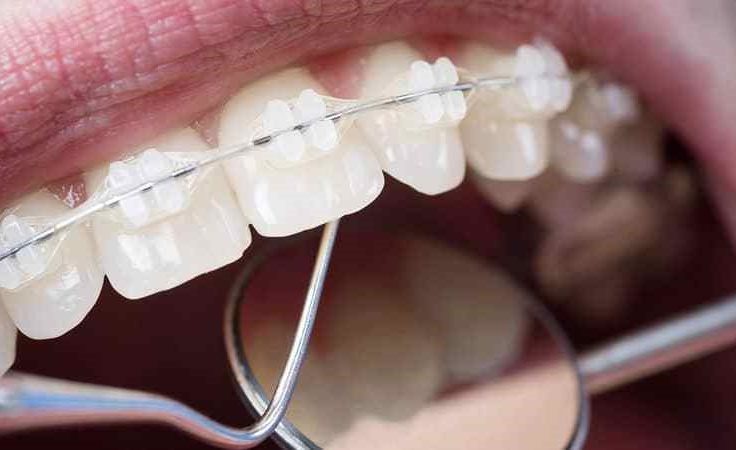 How Braces Can Correct a Range of Orthodontic Issues in Stoke-on-Trent