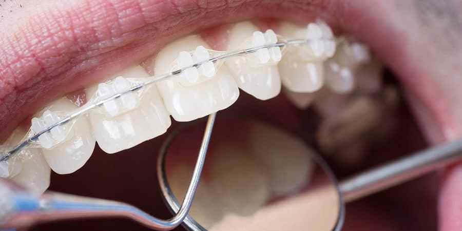 How Braces Can Correct a Range of Orthodontic Issues in Stoke-on-Trent